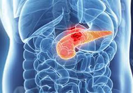 علامات مبكرة تكشف الإصابة بسرطان البنكرياس