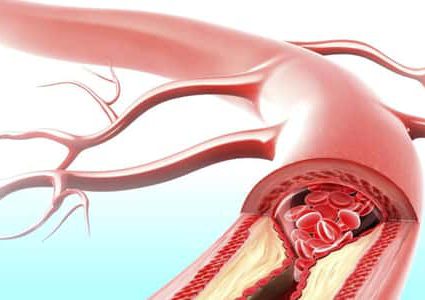 ماذا يعني تكسر الأوعية الدموية وكيفية منعها