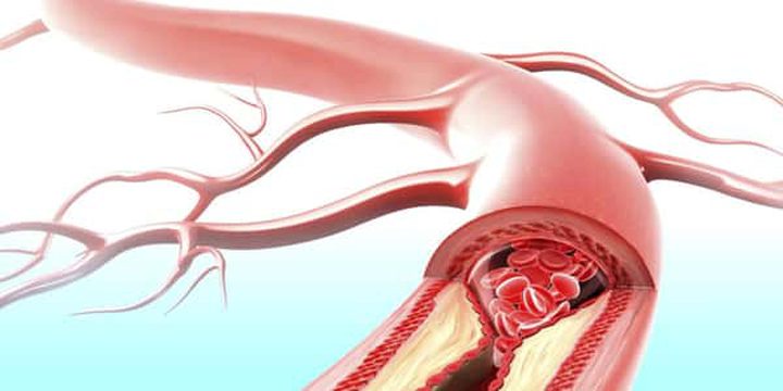 ماذا يعني تكسر الأوعية الدموية وكيفية منعها