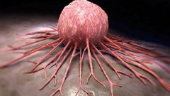 اكتشاف مستحضرات مشعة ... ما علاقتها بالأورام الخبيثة؟