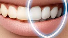 وصفات طبيعية لتبييض الأسنان في المنزل