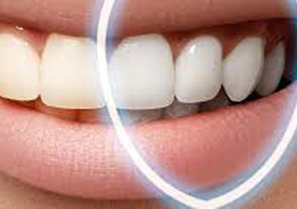 وصفات طبيعية لتبييض الأسنان في المنزل