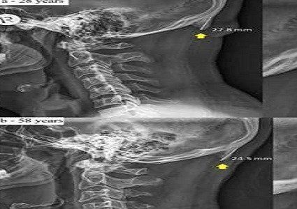 دراسة: الهواتف الذكية تسبب ظهور "شوكة الجمجمة"
