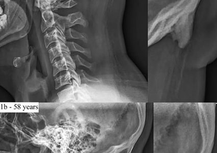 الهواتف تغير الهيكل العظمي البشري بسبب الضغط على الجمجمة