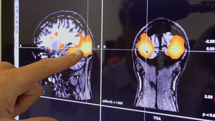 دراسة: إصابات الدماغ الخفيفة قد تسبب عجزا بوظائف الجسم