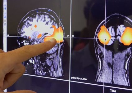 دراسة: إصابات الدماغ الخفيفة قد تسبب عجزا بوظائف الجسم