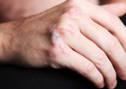 ما هو الفرق بين الصدفية والاكزيما ؟