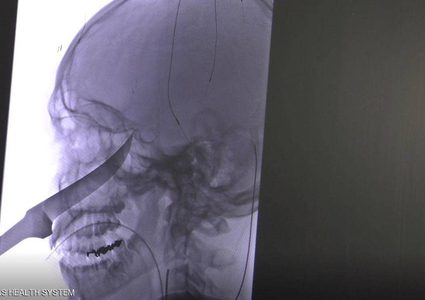 سكين طوله 25 سنتيمترا في الجمجمة.. كيف نجا هذا المراهق؟