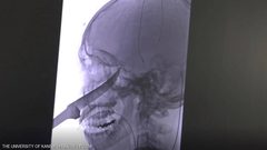 سكين طوله 25 سنتيمترا في الجمجمة.. كيف نجا هذا المراهق؟