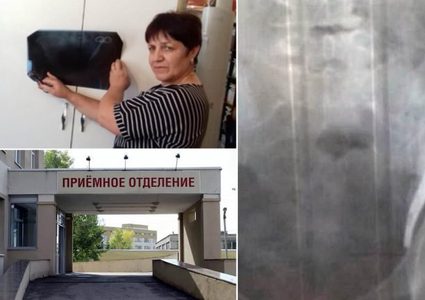 تواجد لمدة 23 عاما.. روسية تصدم بوجود مقص عمليات داخل بطنها!