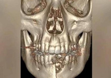 سيجارة الكترونية تنفجر في وجه مراهق أمريكي وتتركه مشوها!