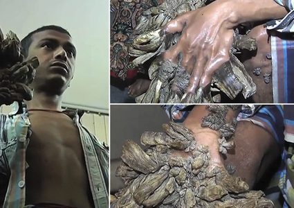 "رجل الشجرة" يتوسل لقطع يديه بعد خضوعه لـ25 عملية جراحية