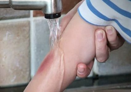 5 طرق طبيعية لعلاج الحروق البسيطة في المنزل