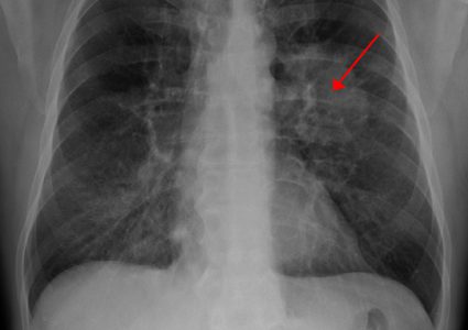 دراسة: تناول مضادات الاكسدة بكثرة يؤدي لانتشار مرض سرطان الرئة