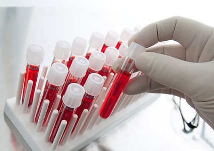 هل يمكن قياس قوة "الارتجاج في الدماغ" من خلال اختبار الدم ؟