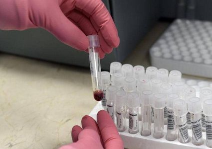 أطباء يزيلون فيروس الإيدز من جينات حيّة