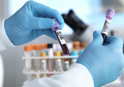 تدني مستوى الكوليسترول الضار يزيد من خطر الاصابة بالسكتة الدماغية