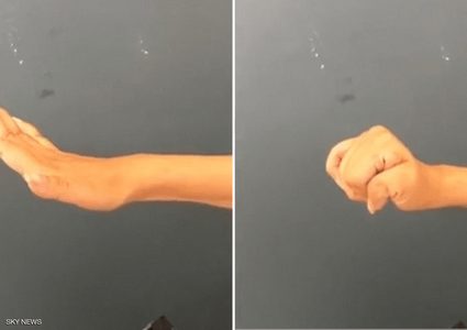 جراحة تعيد وظائف اليد والذراع للمصابين بالشلل