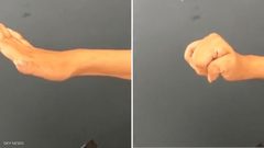 جراحة تعيد وظائف اليد والذراع للمصابين بالشلل