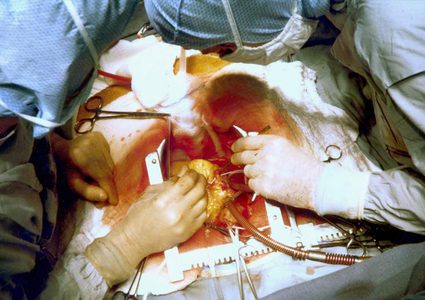 ارتفاع الكالسيوم في الشرايين التاجية يؤذي القلب