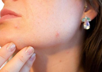 أغذية تسرع ظهور "حب الشباب"