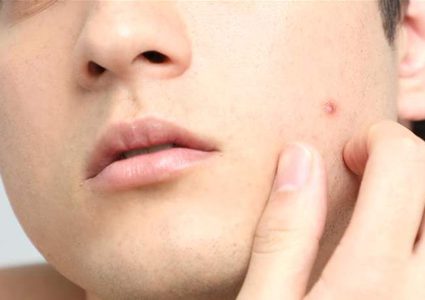 أطعمة تؤدي إلى ظهور "حب الشباب".