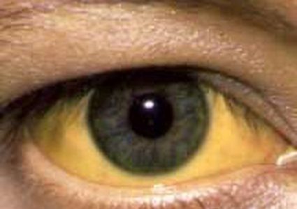 دراسة : اصفرار العين مؤشر على الإصابة بأمراض خطيرة