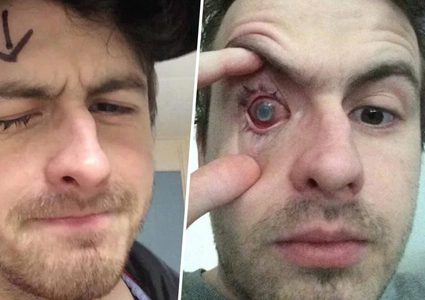 لاعب كرة قدم بريطاني يفقد بصره بسبب العدسات اللاصقة