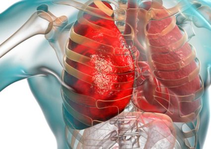 ما هي العوامل التي تزيد من خطر إصابتك بالالتهاب الرئوي