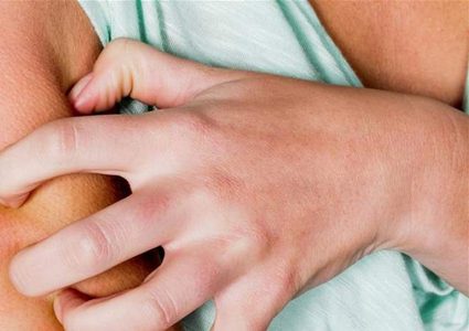 حلول لدغات الباعوض