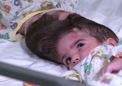 أطباء بريطانيون ينجحون بفصل توأمتين ملتصقتين من الرأس