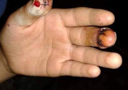 إصابة 10 اشخاص بالالعاب النارية بعد اعلان نتائج "التوجيهي"