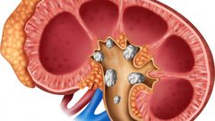 أولى علامات الحصى في الكلى