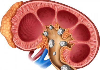 أولى علامات الحصى في الكلى