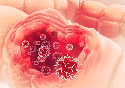 معلومات قد لا تعرفها عن سرطان القولون