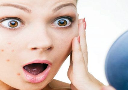 أبرز المشاكل الجلدية التي تواجهها الفتيات في مرحلة المراهقة