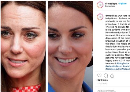 حقنة بيبي بوتكس تسبب ضجة لكيت ميدلتون!