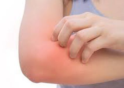 طرق علاج  الطفح الحراري في الصيف