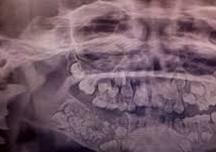 اقتلاع 523 سنًّا من فم طفل!