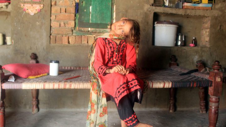 باكستان.. طفلة تعيش 11 عامًا بعنق ملتوي 90 درجة !