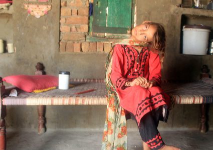 باكستان.. طفلة تعيش 11 عامًا بعنق ملتوي 90 درجة !