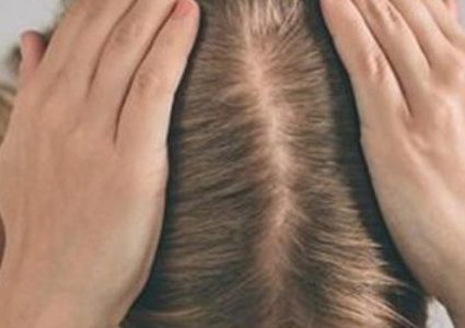 أهم أسباب وأعراض الإصابة بمرض الثعلبة