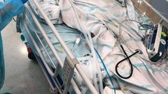 تركيب جمجمة صناعية للطفل الجريح  اشتيوي