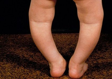 دراسة: الأطفال أصحاب البشرة الداكنة أكثر عرضة للإصابة بمرض الكساح