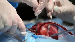 تجربة جديدة لزراعة قلوب الخنازير في أجسام البشر!