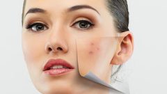 عادات يومية تمنع ظهور حب الشباب