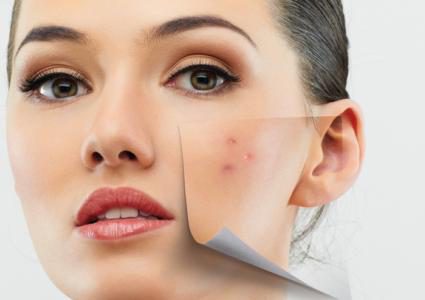 عادات يومية تمنع ظهور حب الشباب