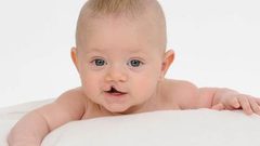 أعراض خفية تؤكد إصابة الطفل بشق بالفم