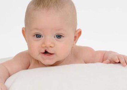 أعراض خفية تؤكد إصابة الطفل بشق بالفم