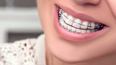 ما هي خطوات العناية بتقويم الأسنان ؟